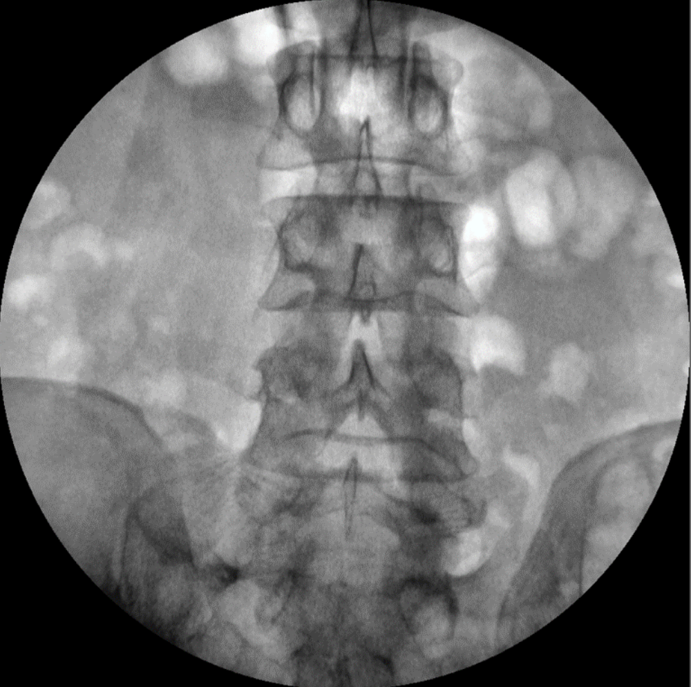 ZX 2090 Turbo Ramię typu C Radiologia Genoray TAG Medical