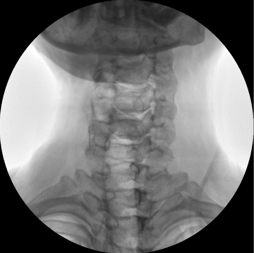 ZX 2090 Turbo Ramię typu C Radiologia Genoray TAG Medical