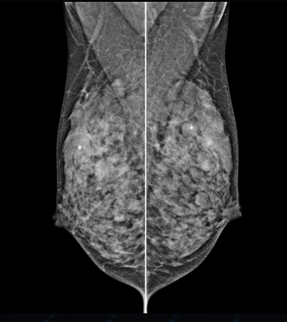 Hestia Mammograf Genoray TAG Medical Hestia Mammograf Genoray TAG Medical