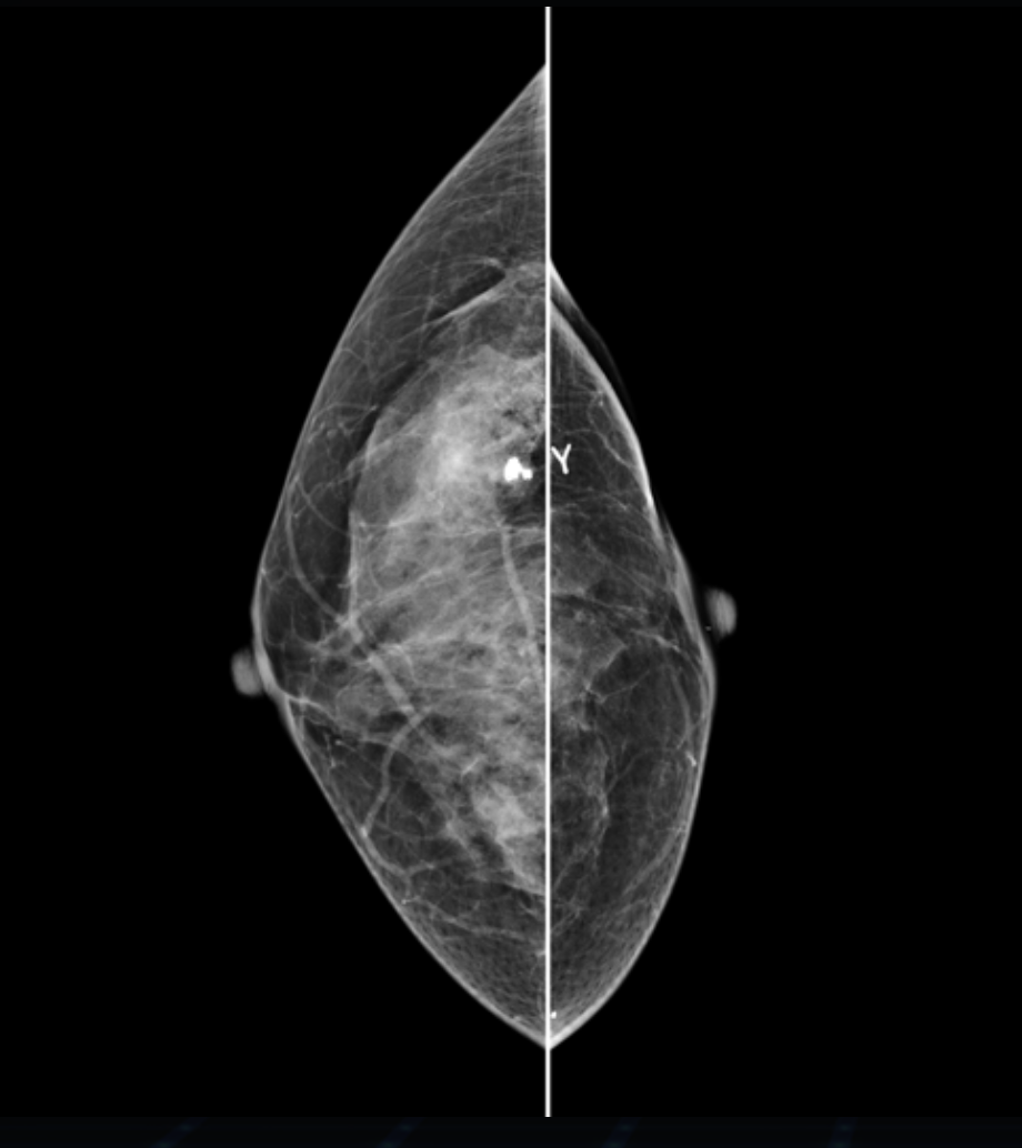 Hestia Mammograf Genoray TAG Medical Hestia Mammograf Genoray TAG Medical