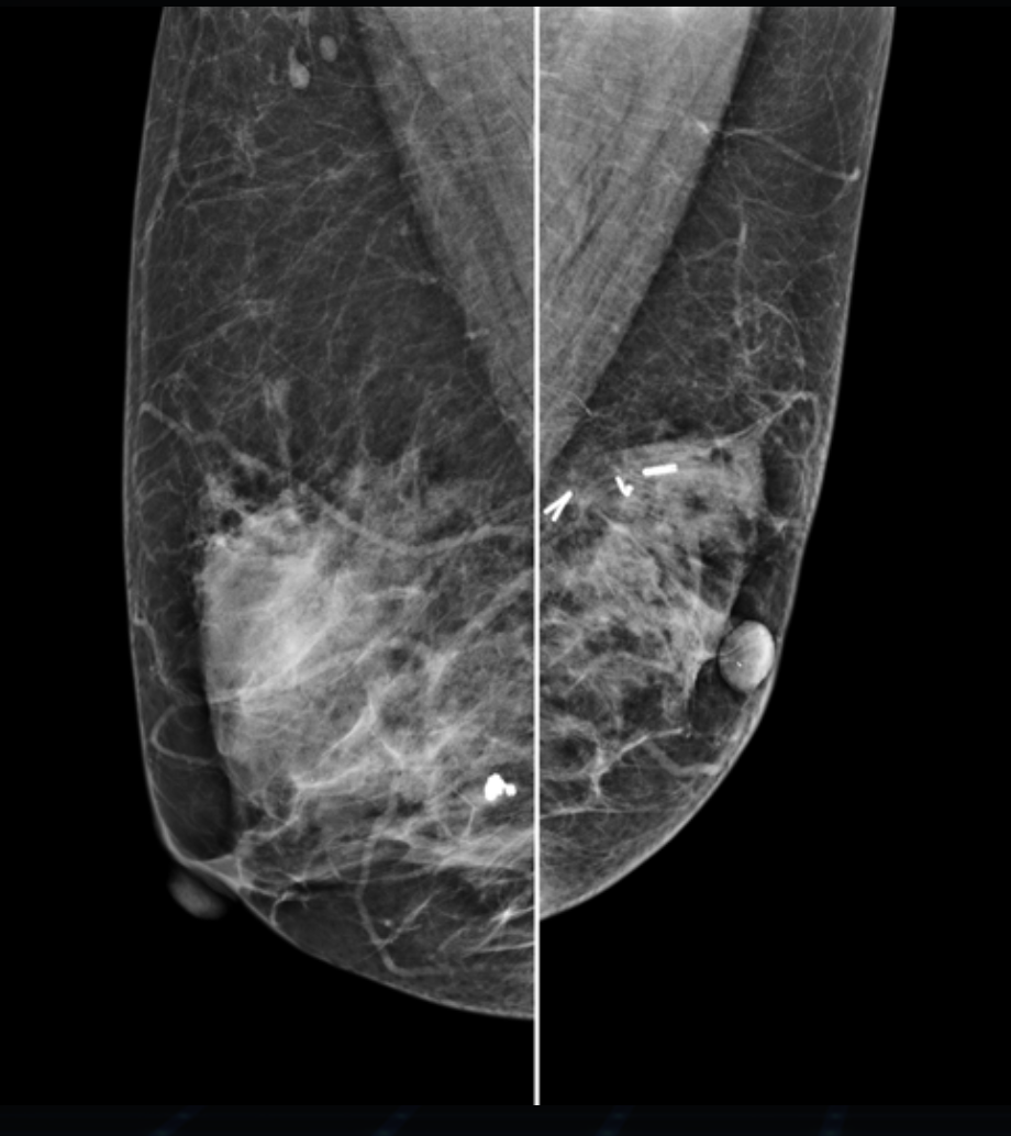 Hestia Mammograf Genoray TAG Medical Hestia Mammograf Genoray TAG Medical