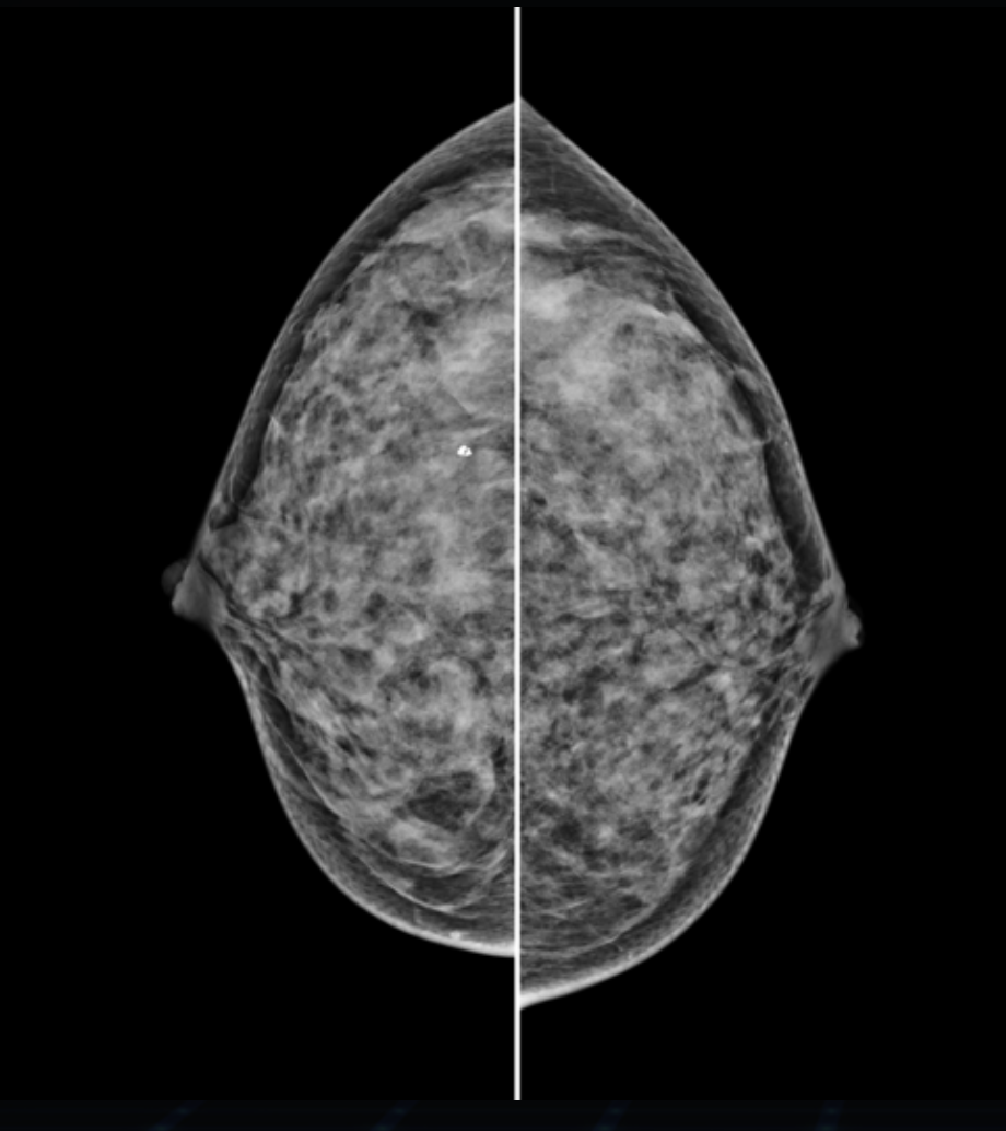 Hestia Mammograf Genoray TAG Medical Hestia Mammograf Genoray TAG Medical